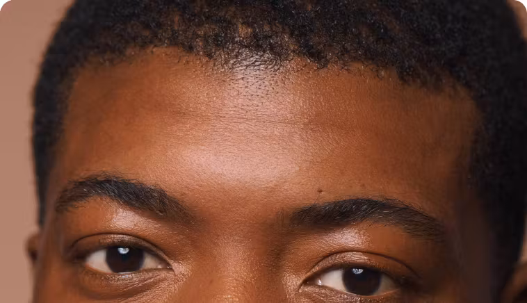 Result - Plasma Hair Restoration