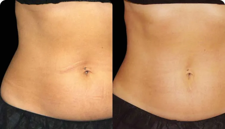 Result - Emsculpt® NEO