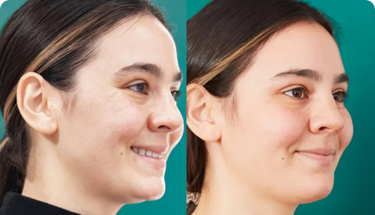 Result - Clear + Brilliant® Laser Facial