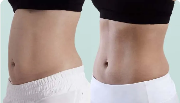 Result - Emsculpt® Body Toning