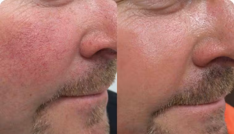 Result - Lumecca IPL Photofacial