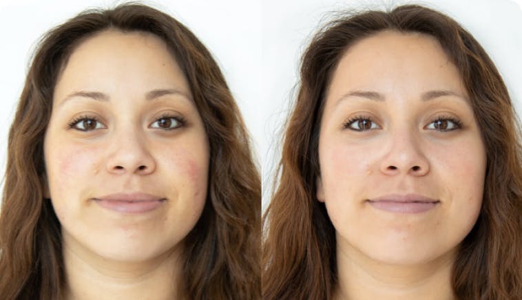 Result - Hydrafacial™