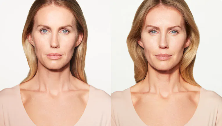 Result - Sculptra®