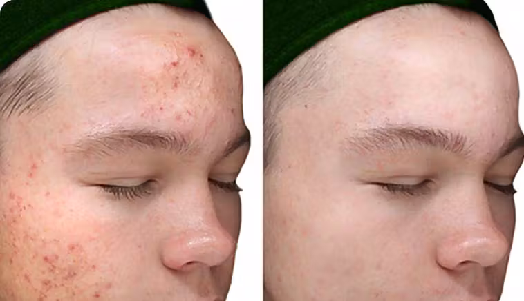 Result - VI Peel®