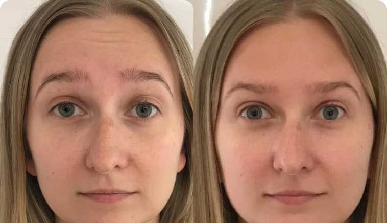 Result - Botox® & Wrinkle Relaxers