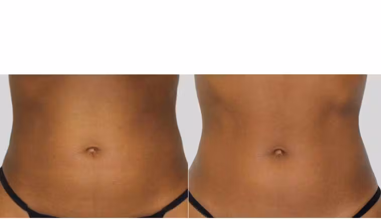 Result - truSculpt® iD